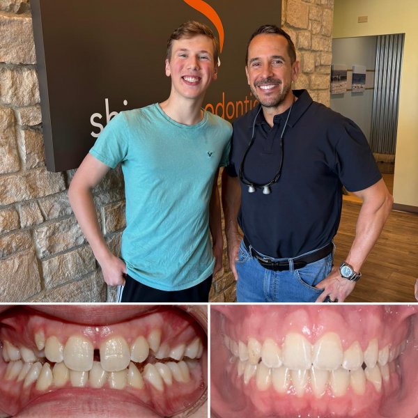 Boy and man smiling and a set of teeth before aligners and a set of teeth after aligners 