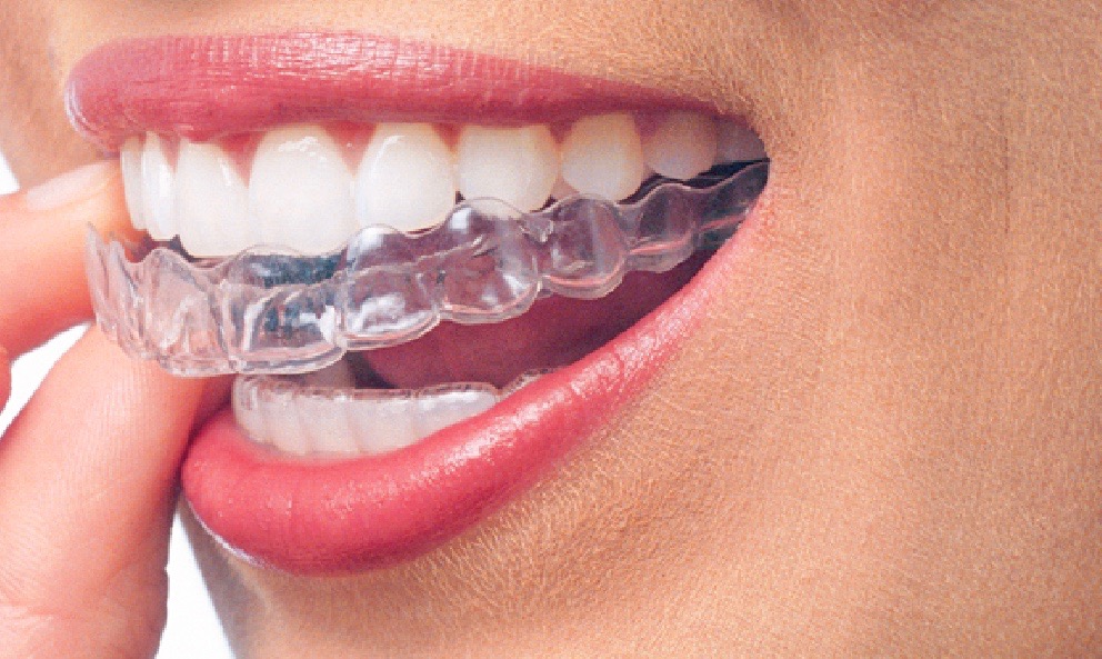 What is Invisalign and How Does It Move Teeth (Part 1)?